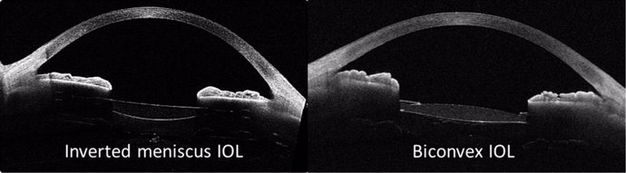 Imagen de las lentes intraoculares