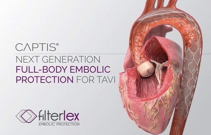 In the new study published in EuroIntervention, Filterlex Medicals CAPTIS system captured a high number of embolic debris particles, showing promise in providing embolic protection and enhancing safety during TAVR procedures.