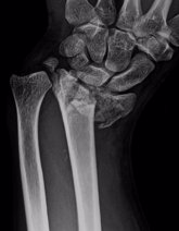 Foto: La mortalidad de las fracturas osteoporóticas por fragilidad supera el 15% anual