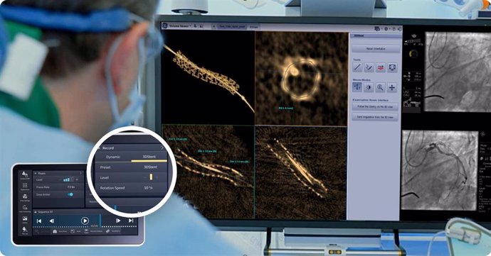 GE HealthCare presenta una innovación para ayudar a los cardiólogos intervencionistas a visualizar un stent coronario en 3D durante el procedimiento