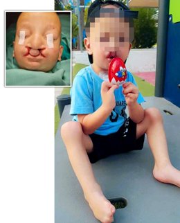 Niño intervenido en el Hospital Vithas Valencia 9 de Octubre