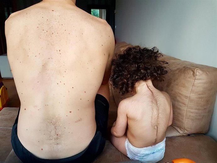 Archivo - Bebé afectado de hipertricosis -exceso de bello- por haber ingerido falso omeprazol