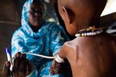 Foto: La OMS publica una nueva directriz para abordar la desnutrición aguda en niños menores de cinco años