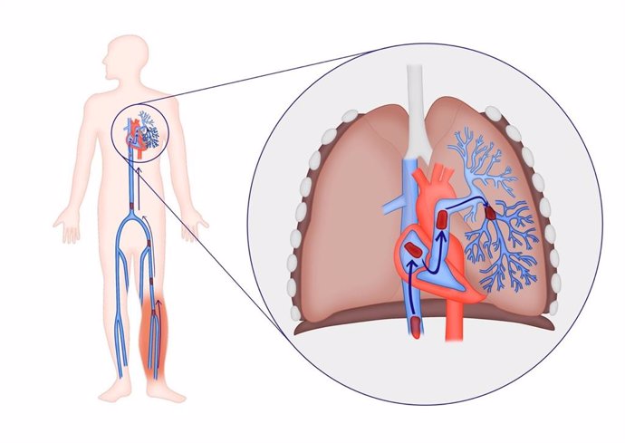 Tromboembolismo pulmonar.