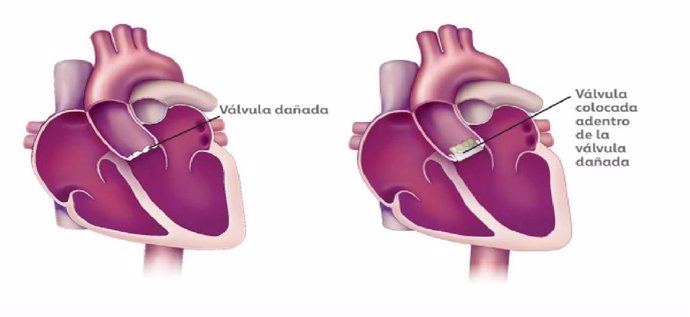 El Hospital Viamed Montecanal implanta por primera vez una válvula aórtica sin cirugía a una paciente.