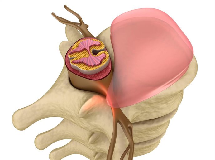 1 De Cada 5 Hernias Discales Puede Cronificarse