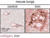 Foto: Revelan el papel esencial que la acumulación de hierro tiene en el desarrollo de enfermedades fibróticas