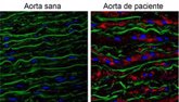 Foto: Descubren que la acumulación de la proteína Versicano es responsable de los aneurismas de aorta del síndrome de Marfan