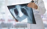 Foto: La disfunción pulmonar a largo plazo está asociada a la edad avanzada y la dificultad respiratoria aguda