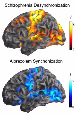 Imagen que muestra la similitud entre las áreas afectadas en el cerebro de una persona con esquizofrenia (figura superior) y las áreas donde se concentran las neuronas estudiadas (figura inferior)
