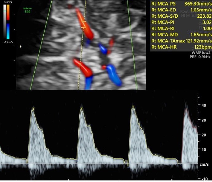 Un estudio avala una prueba ecográfica al final del embarazo para detectar a bebés de riesgo