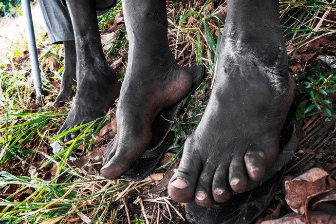Archivo - Jul 31, 2014 - Gulu, Uganda - BOB age 51 and Phillip age 47 and others sit with Gunshots in all parts, they survived a massive massacre while LRA raided their village as UPDF entered cross firing. All survivals were forced to seek refuge in co
