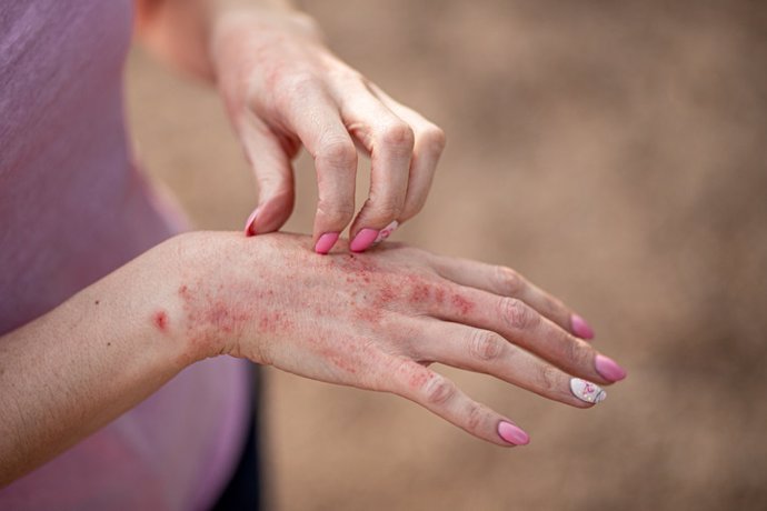 Archivo - Eczema dermatitis.