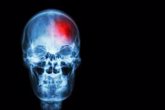 Foto: Sufrir un derrame cerebral puede aumentar significativamente el riesgo de desarrollar demencia