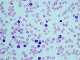 Foto: Nueva estrategia para destruir células madre de leucemia