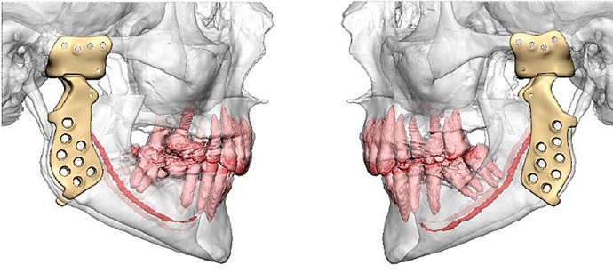 Simulación de las prótesis.