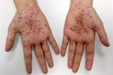 Foto: Acción Psoriasis asegura que padecer enfermedades raras de la piel es todavía un reto para los pacientes