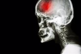Foto: Después de una conmoción cerebral hay más riesgo de niveles altos de hierro