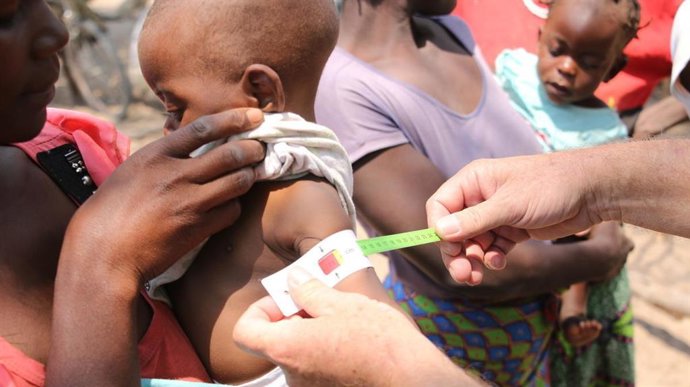 Beto es un niño de 6 meses con desnutrición severa que recibe tratamiento del proyecto nutricional de World Vision.