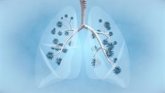 Foto: Dos estudios españoles identifican miRNA vinculado a la persistencia de secuelas pulmonares en pacientes con Covid-19