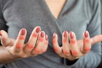 Confirman que las enfermedades reumáticas pueden provocar problemas reproductivos