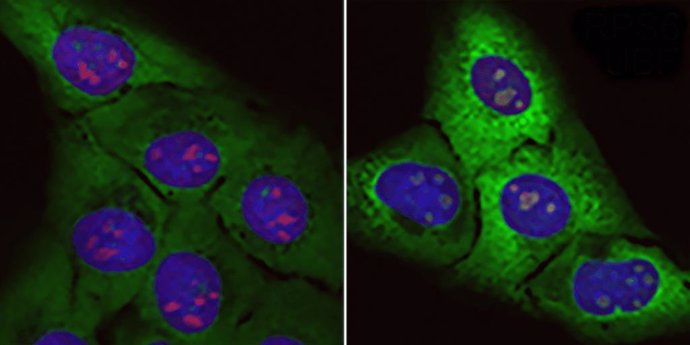 Acumulación de “proteínas basura”: Células normales (izquierda) y células sometidas al efecto de la proteína tóxica rica en arginina (derecha). En esta se incrementan las proteínas ribosomales (verde fluorescente) y el tamaño de los nucléolos (rojo).