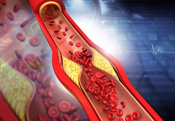 Archivo - Arteria bloqueada por placas de colesterol.