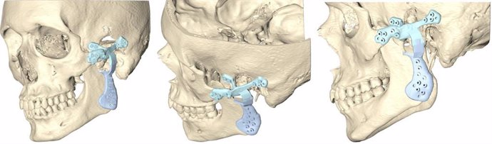 Reconstrucción de la articulación temporomandibular.