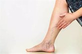 Foto: El dolor de piernas habitual, la pesadez o las varices pueden ser síntomas de reflujo venoso, según experto