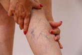 Foto: El dolor y pesadez habitual de piernas podrían tratarse de "signos de reflujo venoso", según experto