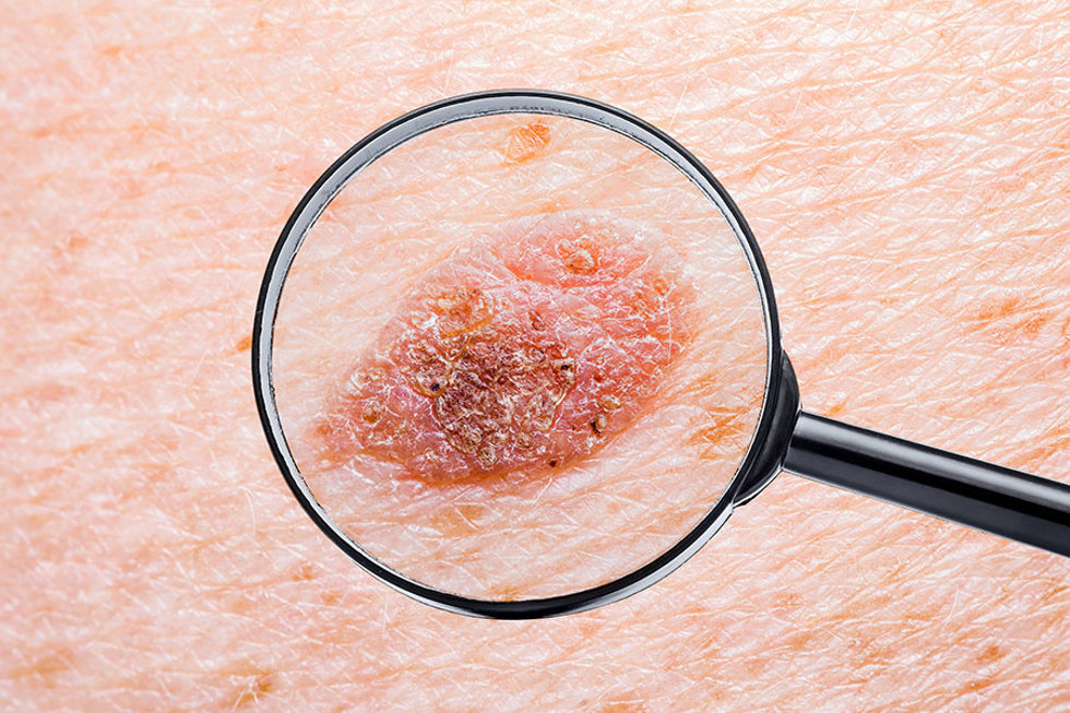 Melanoma maligno