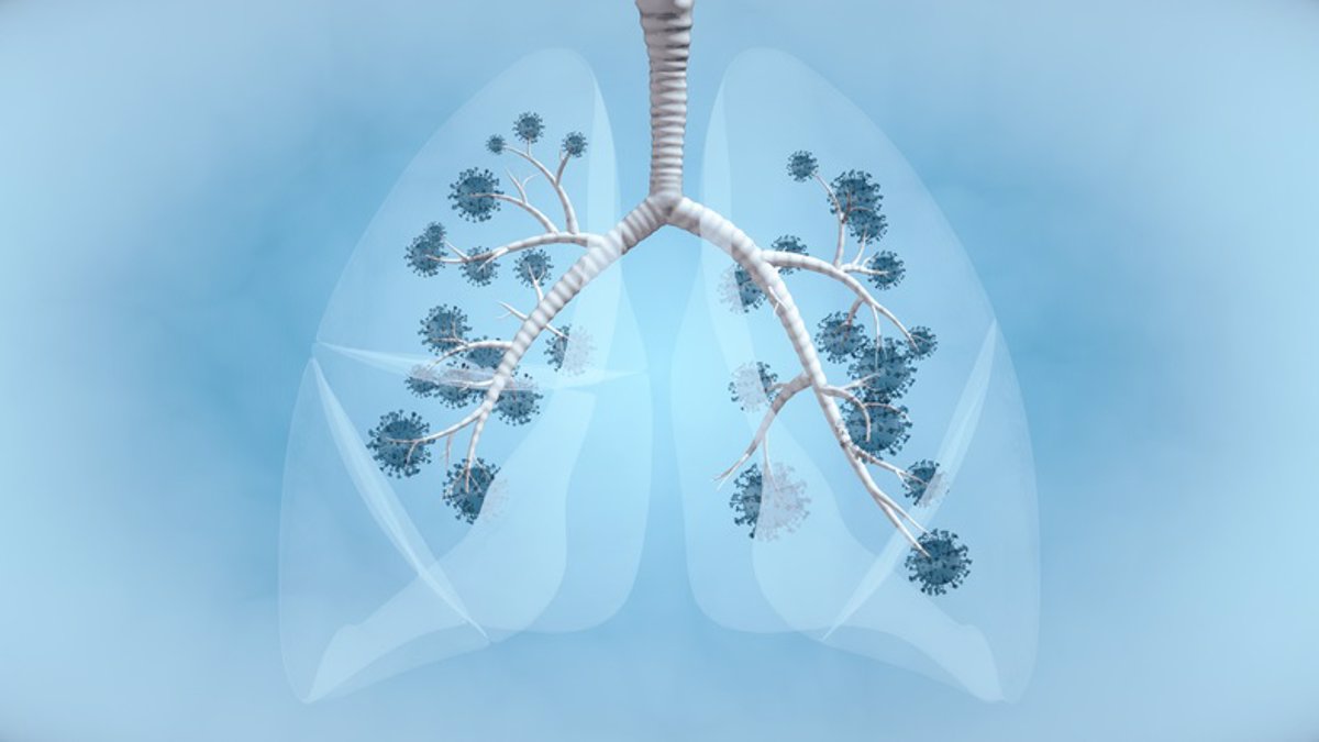 Un tipo de célula inmunitaria del pulmón se relaciona con el COVID grave