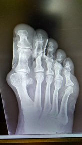 Foto: Los pies son una de las partes del cuerpo más afectadas por los accidentes laborales, según el ICOPCV