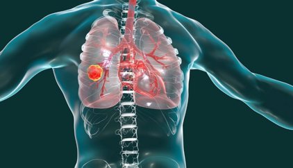 MSD anuncia que la CE ha aprobado 'Keytruda' más quimioterapia para tratar el cáncer de pulmón