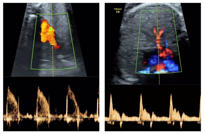 Reactividad vascular de pulmones de fetos demasiado pequeños (a la izquierda, las principales arterias pulmonares; a la derecha, imatge de les arterias intrapulmonares)