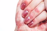 Foto: Las mujeres con artritis psoriásica tienen peor respuesta a los tratamientos que los hombres, según experta