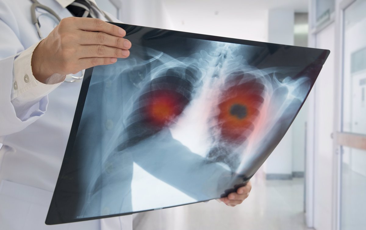 El cribado de cáncer de pulmón en pacientes con EPOC es imprescindible para mejorar la supervivencia