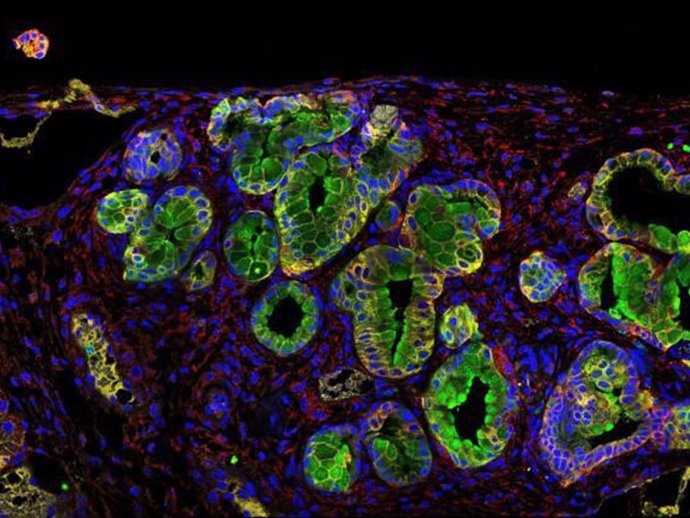 Inmunofluorescencia de un tumor de páncreas; la proteína PGLYRP1 en verde.