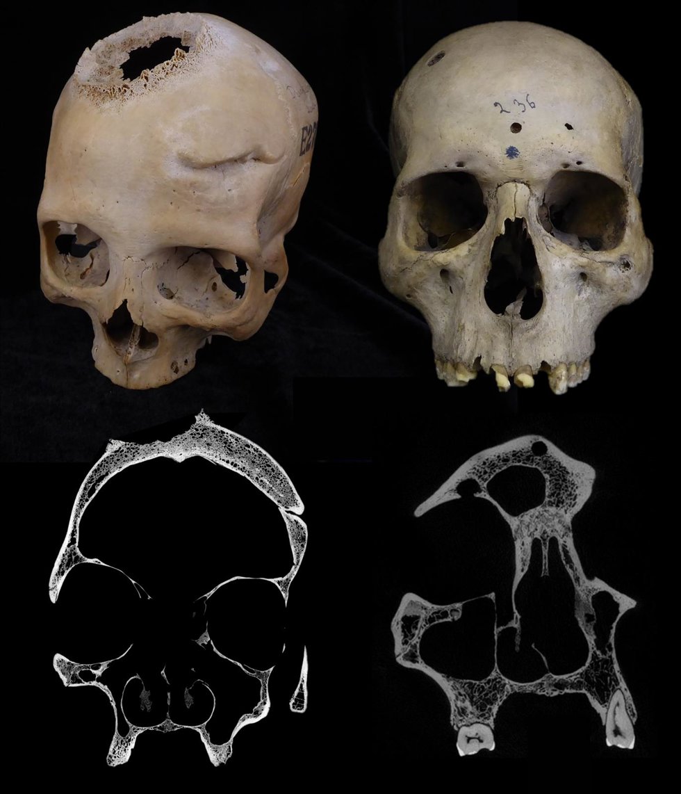 Un estudio de la USC desvela que los egipcios practicaron intervenciones para tratar el cáncer hace 4.000 años