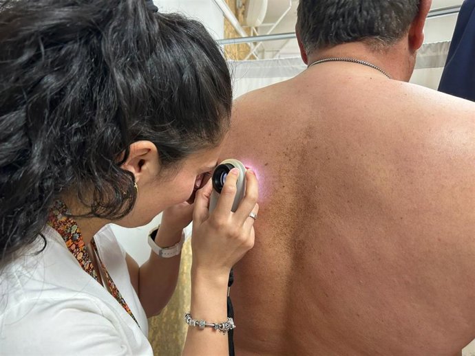 El servicio de Dermatología del Hospital Universitario Costa del Sol ha detectado en 2023 un total de 161 melanomas, en 153 pacientes, puesto que ocho de ellos presentaba más de un melanoma al mismo tiempo.