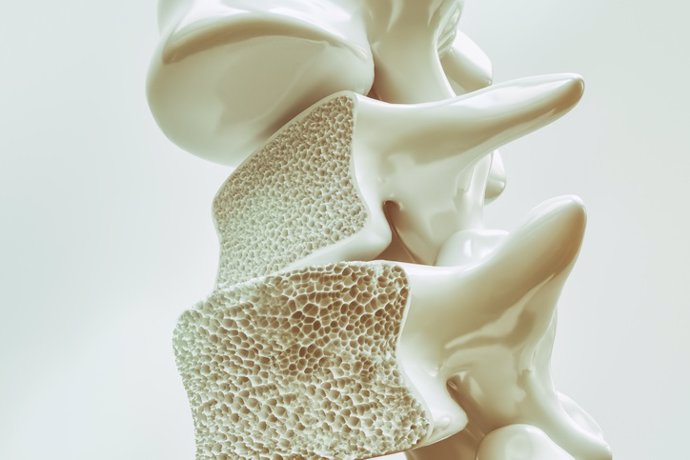 Archivo - Imagen de archivo de osteoporosis.