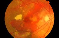 El tabaco provoca enfermedades graves de retina, además de ojo seco y flacidez palpebral