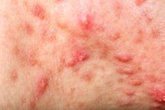 Foto: La detección precoz, clave para mejorar la calidad de vida en pacientes con hidradenitis supurativa