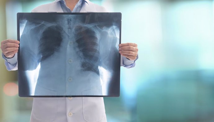 Archivo - Imagen de archivo de una radiografía de pulmones.