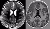 Foto: El Hospital Ruber Internacional ha tratado con éxito a 15 pacientes con el tipo de epilepsia MOGHE en 2024