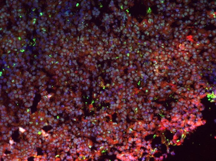 Detalle de células de un insulinoma que expresan insulina (rojo)