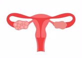 Foto: Síndrome de ovario poliquístico vs ovario poliquístico: puntos a tener en cuenta