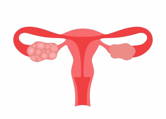 Archivo - Síndrome de ovario poliquístico vs ovario políquistico
