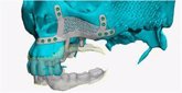 Foto: Reconstruir el hueso maxilar superior es posible gracias a unos implantes dentales subperiósticos