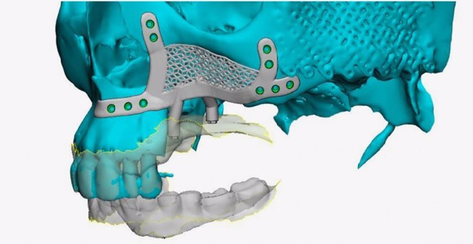 Implantes dentales subperiósticos